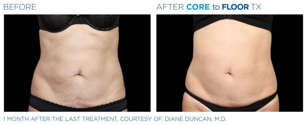 EMSELLA Treatment Results | Before and After