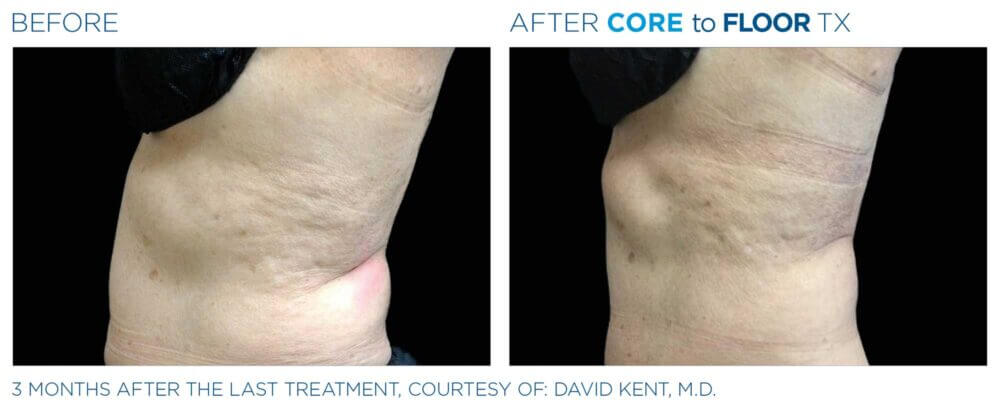 EMSELLA Treatment Results | Before and After