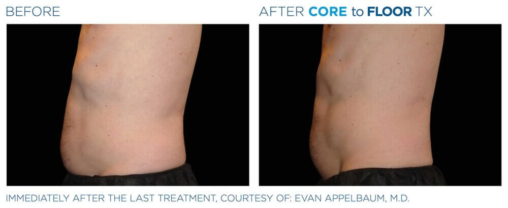 EMSELLA Treatment Results | Before and After