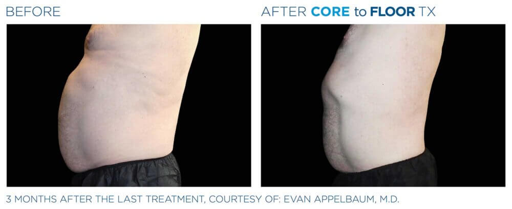 EMSELLA Treatment Results | Before and After